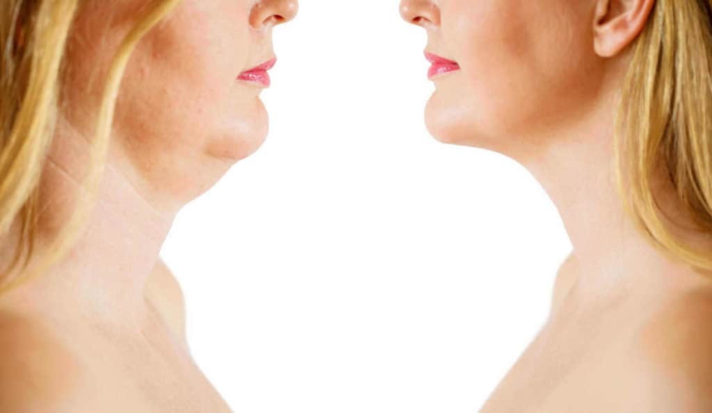Double Chin treatment Basildon before and after results