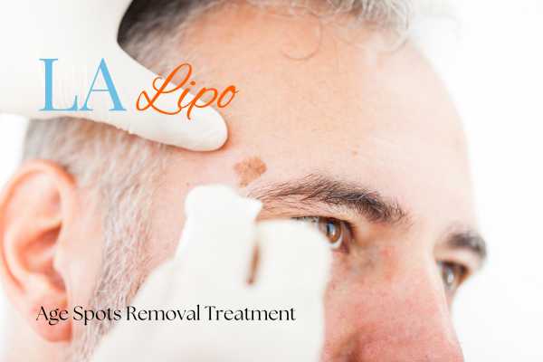 What Are the Most Effective Treatments for Age Spots Basildon?