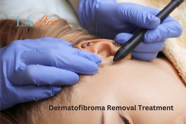 Dermatofibroma Removal Treatment Basildon