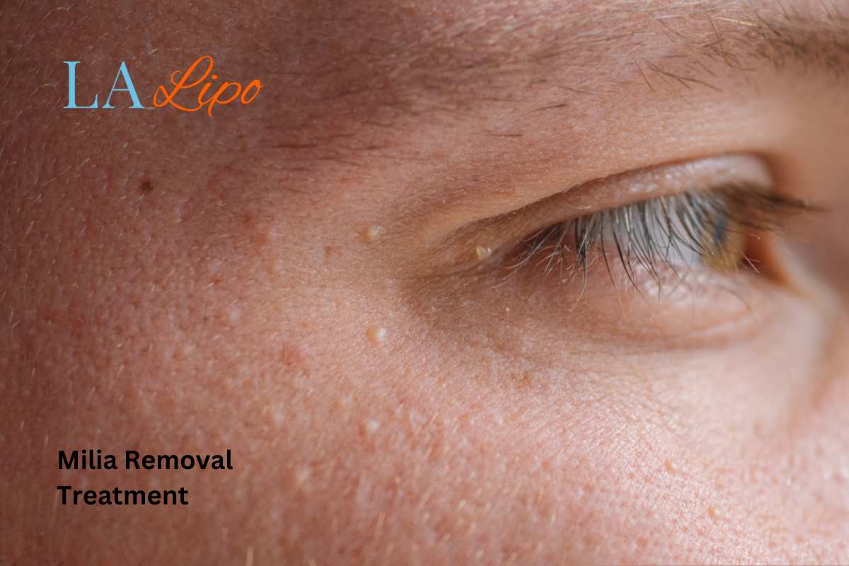 Cryopen Milia Removal: Is It the Easiest and Safest Option Basildon?