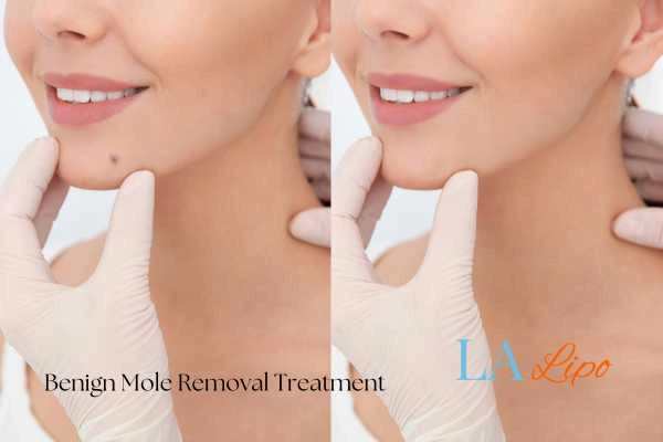 woman's before and after mole removal Basildon results