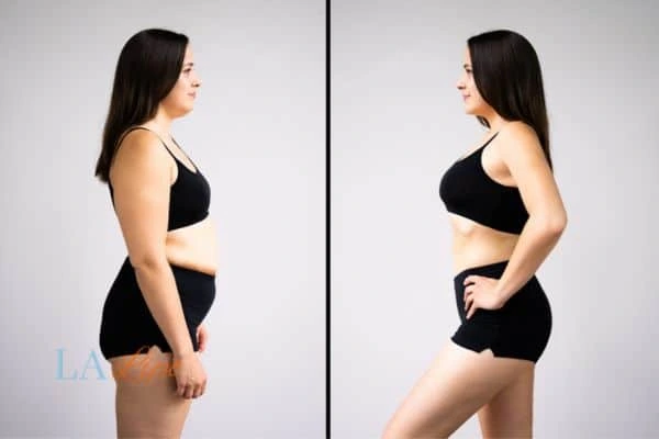 image of woman before and after results of LA-EMS Body Sculpting Basildon to help treat Diastasis recti