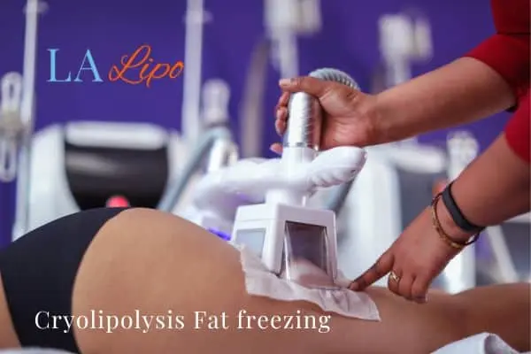 women getting fat freezing Basildon