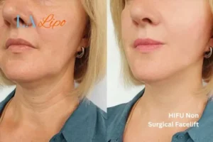 hi-fu for wrinkles Basildon before and after results