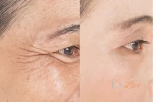 Before and after results of woman - HI-fu wrinkles reduction treatment Basildon