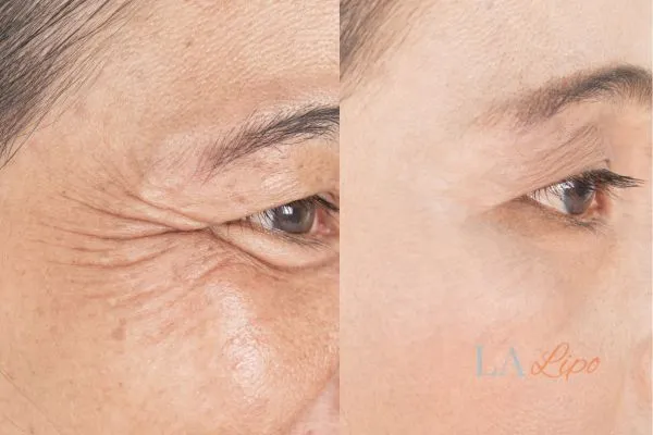 Before and after results of woman - HI-fu wrinkles reduction treatment Basildon