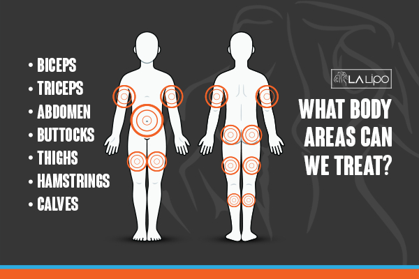 Graphic to show areas you can have LA-EMS Body Sculpting Basildon treatment.