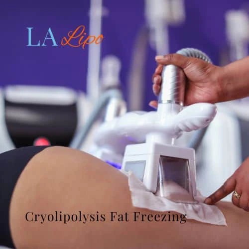 fat freezing - Cryolipolysis Basildon