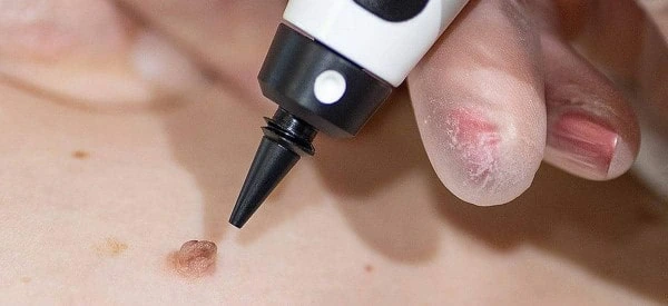 skin tag removal using cryopen Basildon