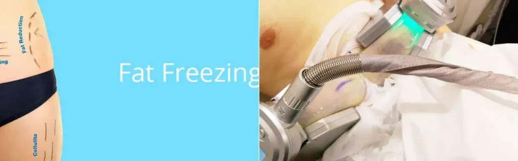 Fat freezing Basildon on multiple areas of the body