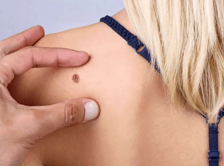 woman having mole removal Basildon consultation before treatment.