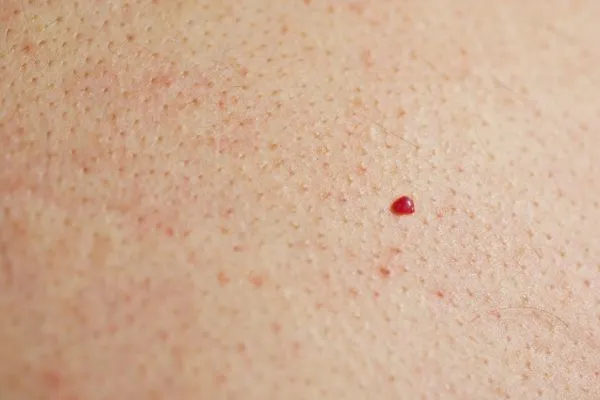 close up of a cherry angioma Basildon
