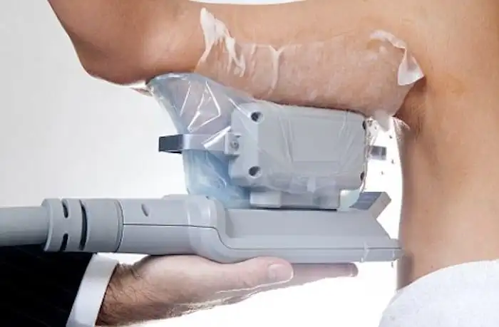 Picture of fat freezing Basildon on the upper arms.