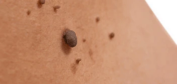 image of a skin tag Basildon