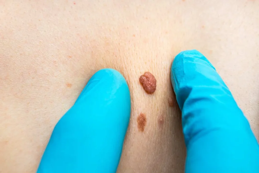 Consultant examining a skin tag Basildon