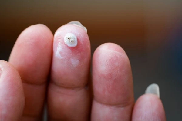 wart on person finger - cryotherapy to treat from LA LIPO Basildon