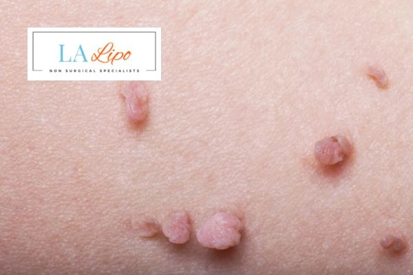 Does cryopen skin tag removal Basildon hurt? Find out now call our team today!