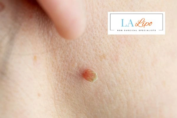 Book skin tag removal Basildon today speak to our team now!