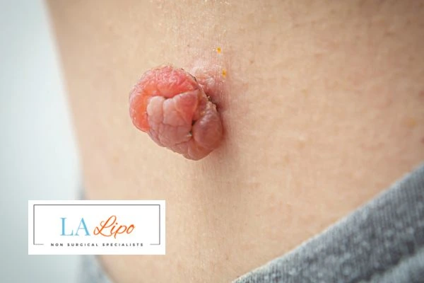 Interested in skin tag removal Basildon? Concerned about the pain? Find out more today!