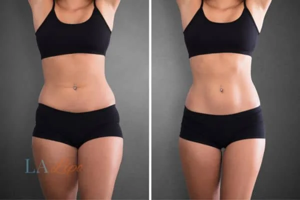 before and after results of non-surgical treatment to help a woman's body image and mental health Basildon