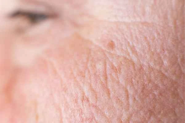 close up picture of a woman's face showing an age spot Basildon