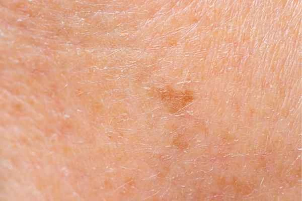 close up picture of age spots Basildon