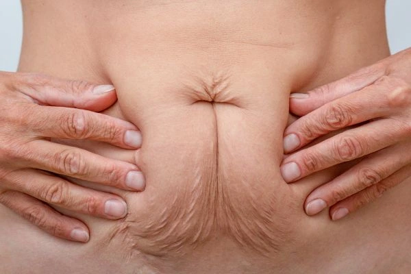 Should I Combine Diastasis Recti Treatment with Body Contouring for Better Results Basildon?