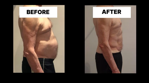 What Symptoms Can Diastasis Recti Cause in Men? Weak Core, Back Pain and Poor Posture Basildon